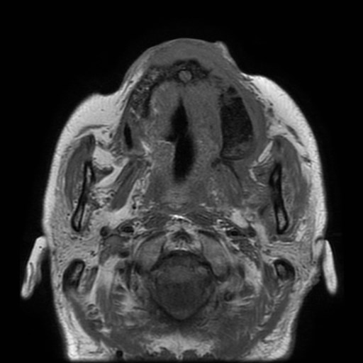 Bisphosphonate-related osteonecrosis of the maxilla (Radiopaedia 51367-57101 Axial T1 23).jpg