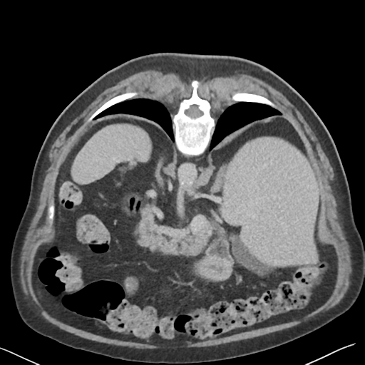 File:Bladder papillary urothelial carcinoma (Radiopaedia 48119-52951 Axial C+ delayed 8).png