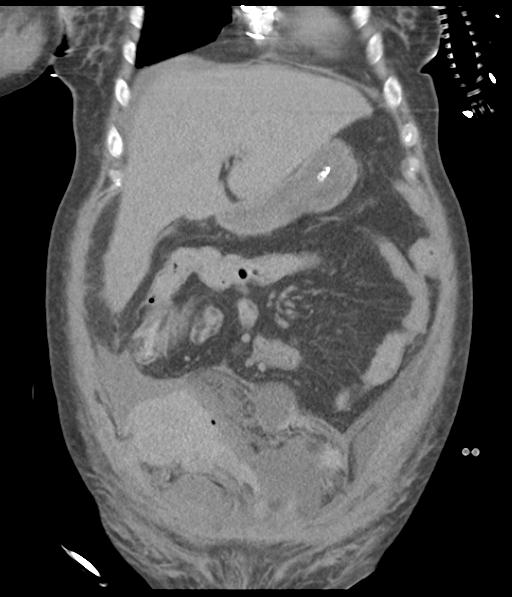 Bladder rupture post renal biopsy (Radiopaedia 30863-31572 Coronal non-contrast 19).jpg