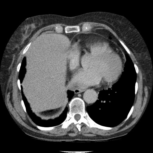 Bladder tumor detected on trauma CT (Radiopaedia 51809-57609 C 10).jpg