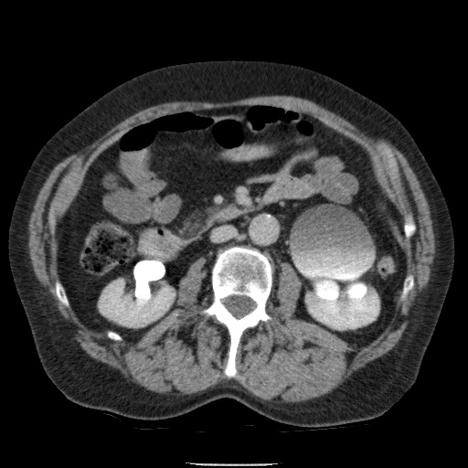 Bladder tumor detected on trauma CT (Radiopaedia 51809-57609 C 61).jpg