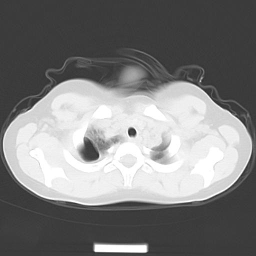 File:Bochdalek diaphragmatic hernia (Radiopaedia 38866-41059 Axial lung window 3).jpg
