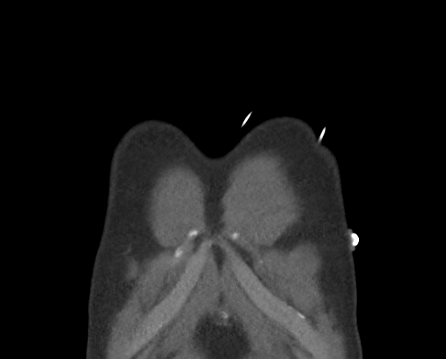 File:Boerhaave syndrome (Radiopaedia 39382-41660 C 8).png