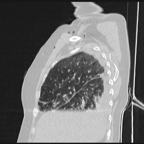 Boerhaave syndrome (Radiopaedia 45644-49799 Sagittal lung window 18).jpg