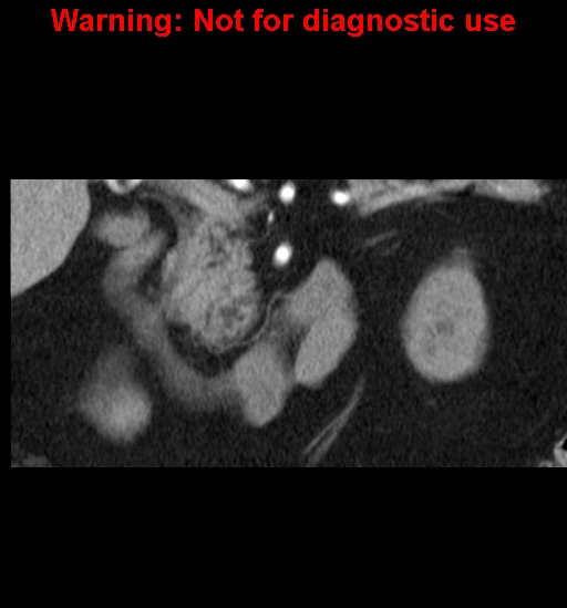 File:Bosniak renal cyst - type IV (Radiopaedia 23402-23466 C 15).jpg