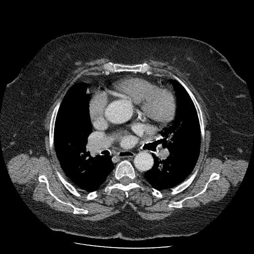 Bovine aortic arch - right internal mammary vein drains into the superior vena cava (Radiopaedia 63296-71875 A 73).jpg
