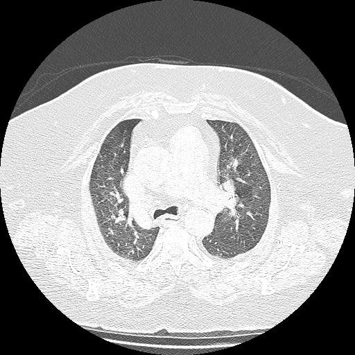 Bovine aortic arch - right internal mammary vein drains into the superior vena cava (Radiopaedia 63296-71875 Axial lung window 53).jpg