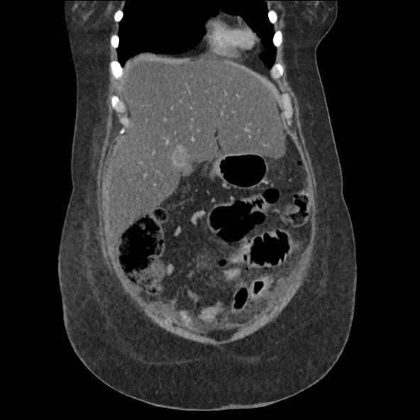 Bowel and splenic infarcts in acute lymphocytic leukemia (Radiopaedia 61055-68915 B 18).jpg