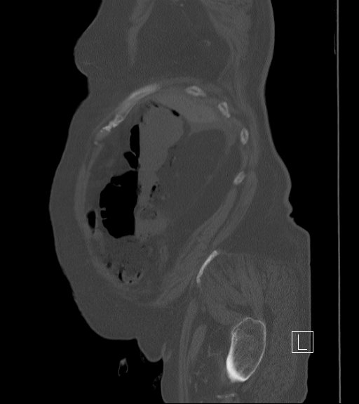 Bowel ischemia secondary to SMA occlusion with extensive portomesenteric venous gas (Radiopaedia 54656-60871 Sagittal bone window 101).jpg
