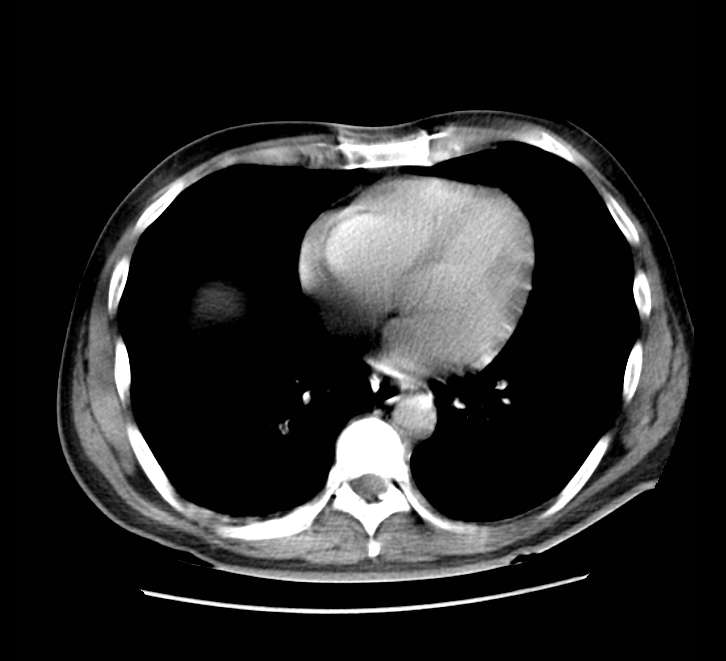 Bowel obstruction from colon carcinoma (Radiopaedia 22995-23028 A 2).jpg