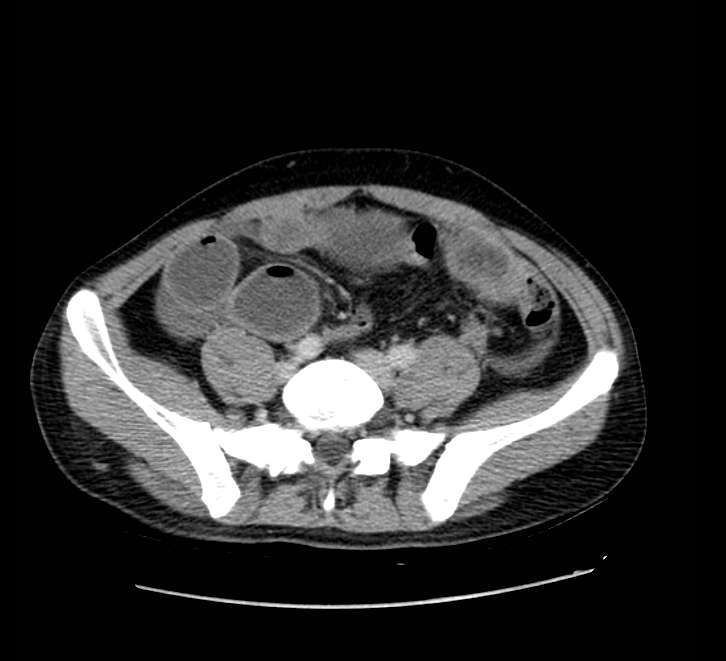 Bowel obstruction from colon carcinoma (Radiopaedia 22995-23028 A 60).jpg