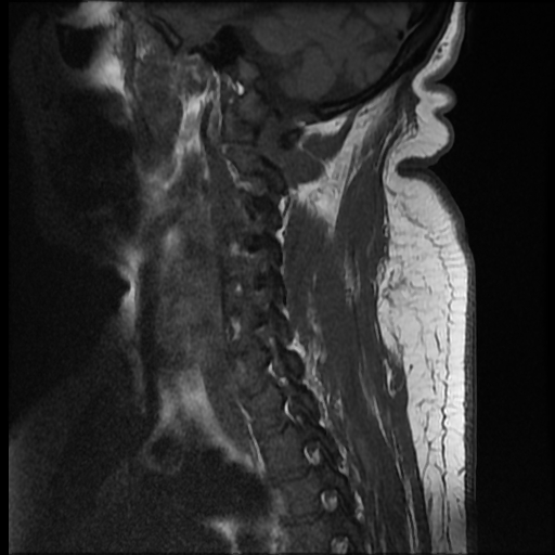 File:Brachial plexopathy (Radiopaedia 21844-21806 Sagittal T1 3).jpg