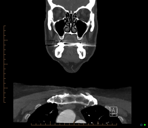 Brachiocephalic trunk stenosis (Radiopaedia 87242-103519 B 14).jpg