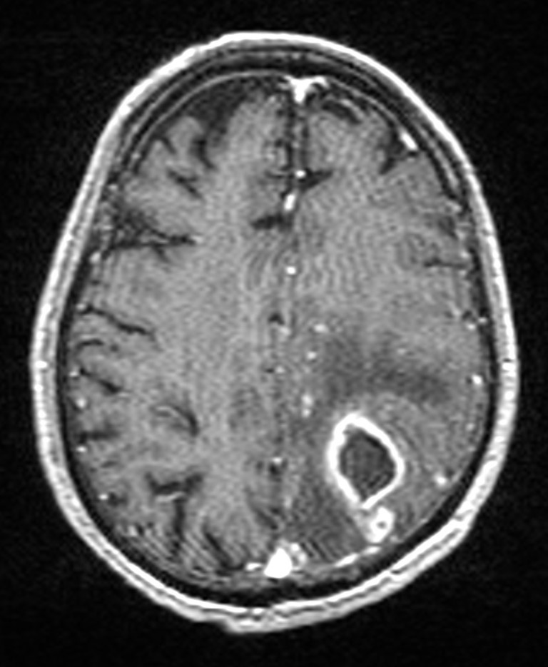 Brain abscess with dual rim sign (Radiopaedia 87566-103938 Axial T1 C+ 116).jpg