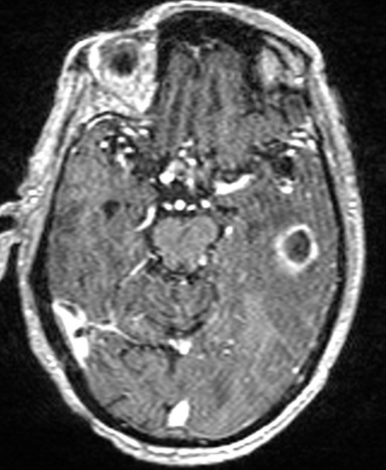 Brain abscess with dual rim sign (Radiopaedia 87566-103938 Axial T1 C+ 66).jpg