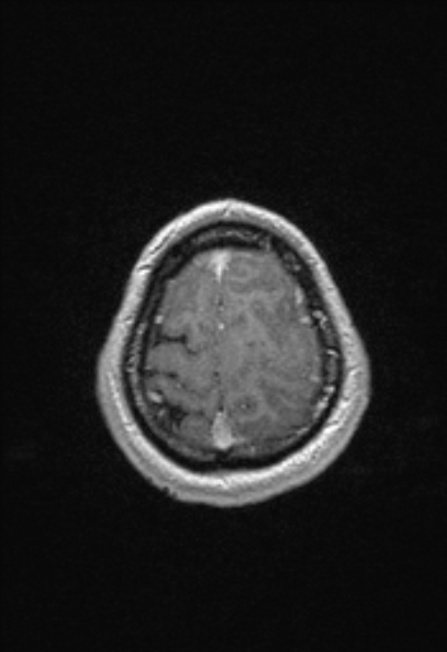 Brain abscess with ventriculitis (Radiopaedia 85703-101495 Axial T1 C+ 150).jpg