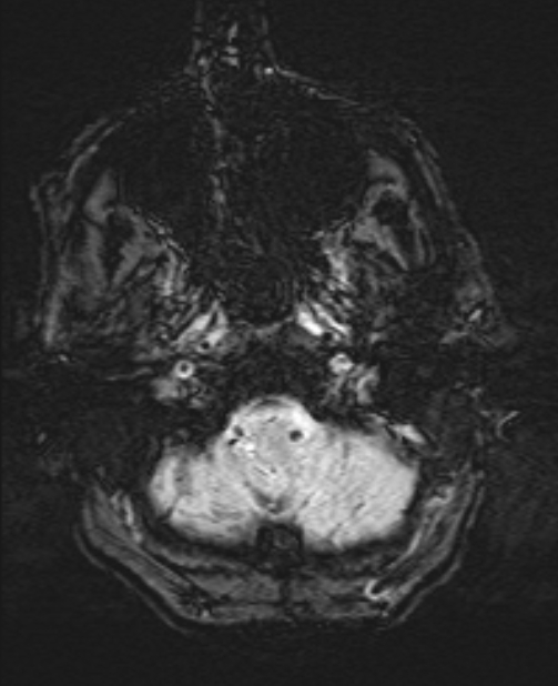 Brain metastases - lung cancer primary (Radiopaedia 75060-86115 Axial SWI 8).jpg