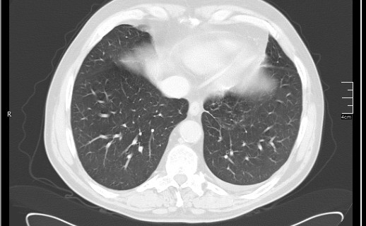 File:Brain metastases from squamocellular lung cancer (Radiopaedia 56515-63219 Axial lung window 49).jpg