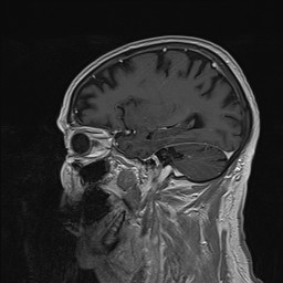 Brain metastasis (Radiopaedia 42617-45761 Sagittal T1 C+ 69).jpg