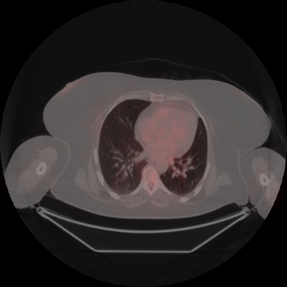 Brain metastasis (Radiopaedia 89847-106962 Axial lung window 37).jpg