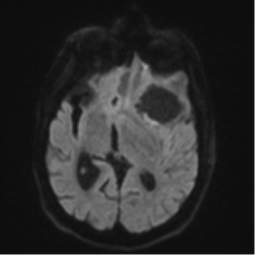 Brain metastasis (lung cancer) (Radiopaedia 48289-53179 Axial DWI 41).png