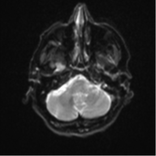 Brain metastasis (sarcoma) (Radiopaedia 47576-52209 Axial DWI 6).png