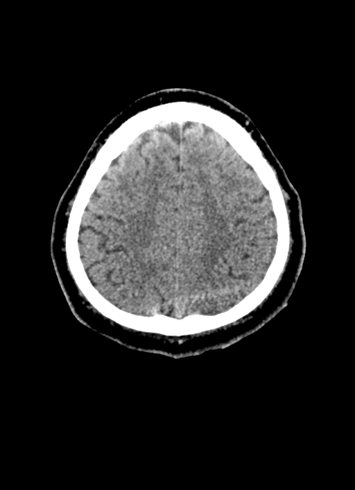 Brainstem hemorrhage (Radiopaedia 81294-94976 Axial non-contrast 17).jpg
