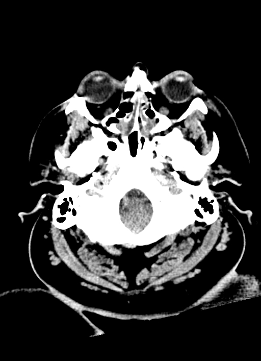 Brainstem hemorrhage (Radiopaedia 81294-94976 Axial non-contrast 54).jpg