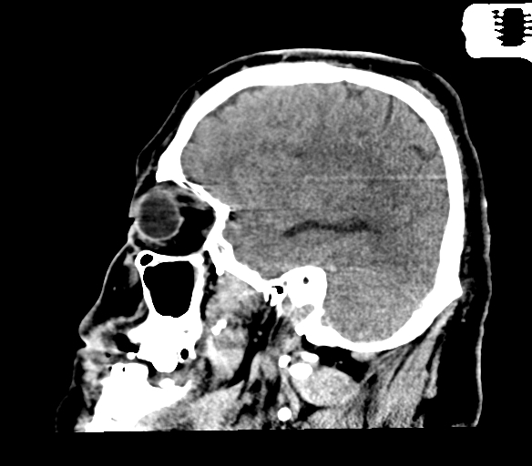 File:Brainstem hemorrhage (Radiopaedia 81294-94976 C 16).jpg
