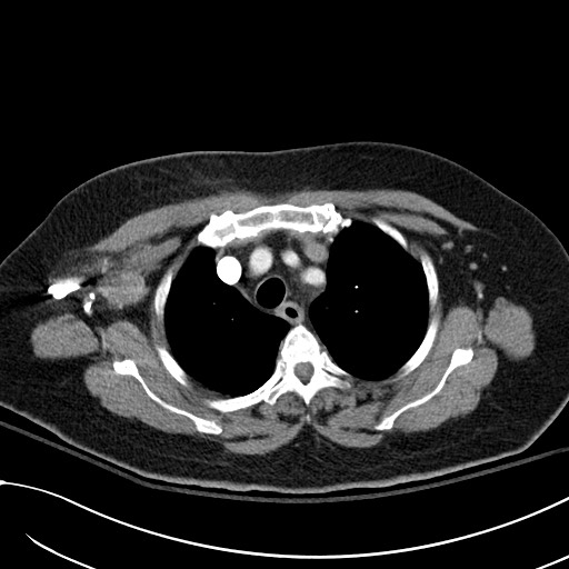 File:Breast carcinoma with pathological hip fracture (Radiopaedia 60314-67974 A 13).jpg