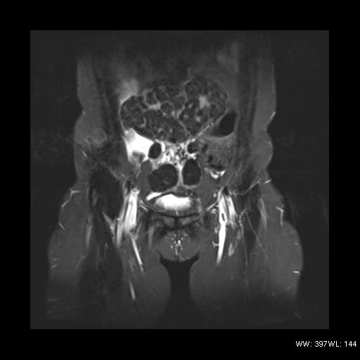 File:Broad ligament fibroid (Radiopaedia 49135-54241 Coronal STIR 6).jpg