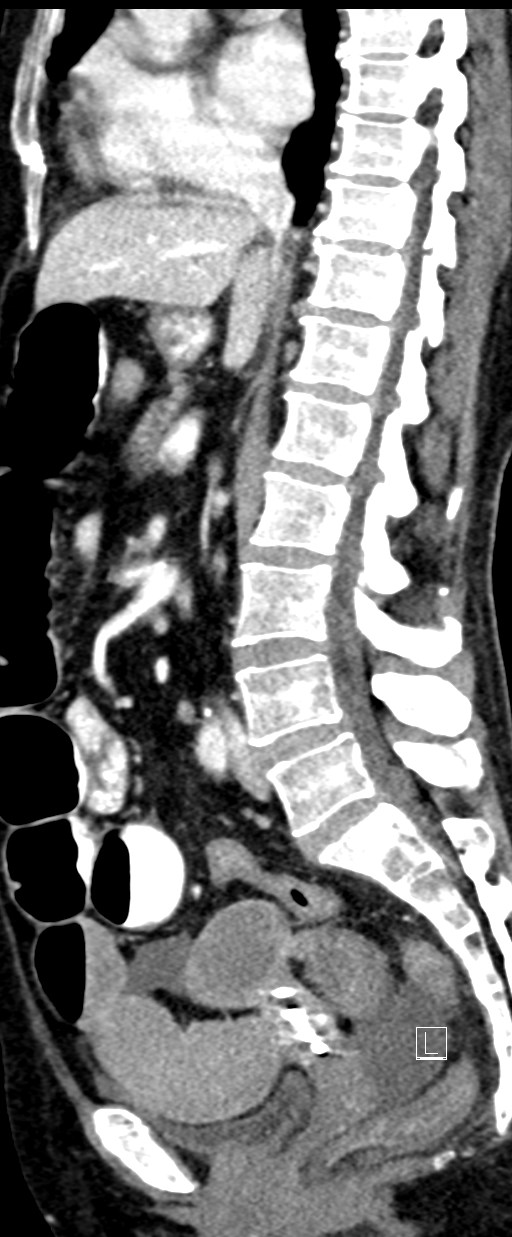 Broad ligament hernia (Radiopaedia 84802-100276 C 40).jpg