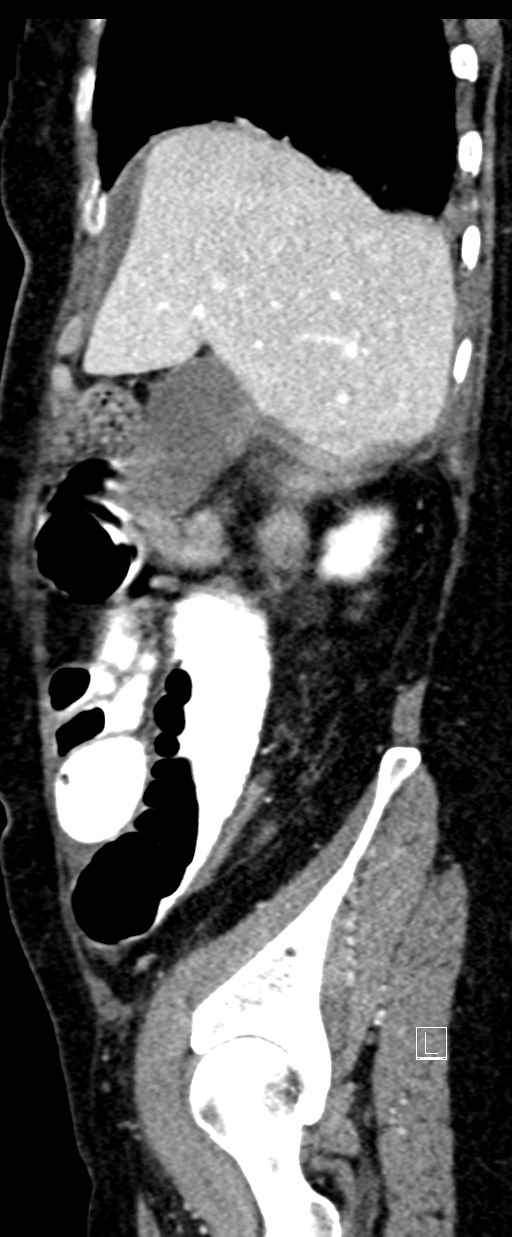 Broad ligament hernia (Radiopaedia 84802-100276 C 66).jpg
