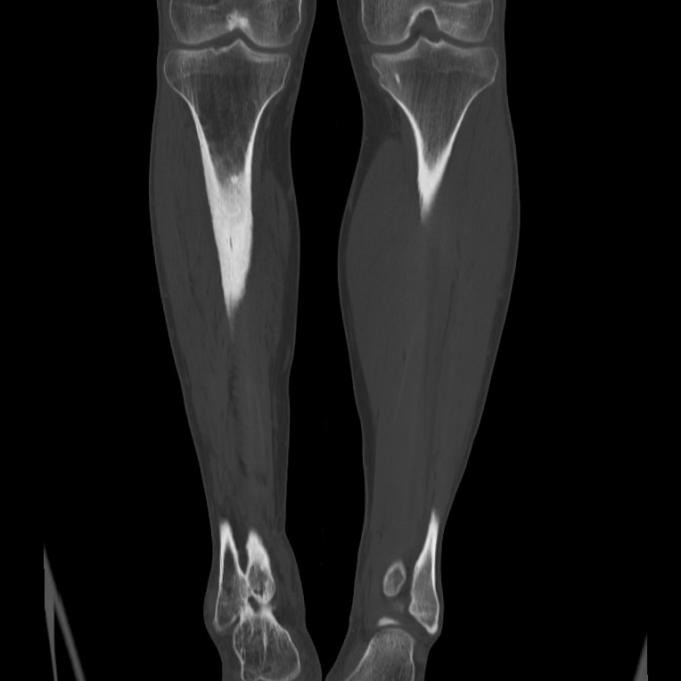 Brodie abscess - tibia (Radiopaedia 66028-75204 Coronal bone window 40).jpg