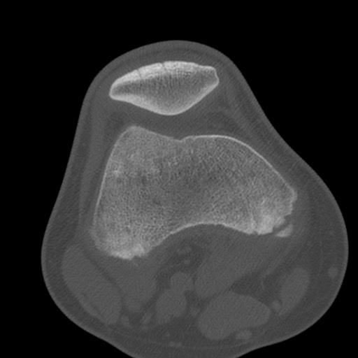 Brodie abscess of the tibia (Radiopaedia 58984-66250 Axial bone window 29).jpg