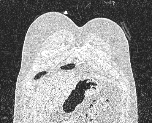 Bronchial atresia (Radiopaedia 58271-65417 Coronal lung window 2).jpg