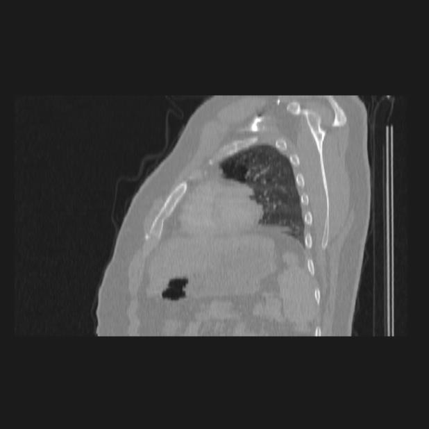 Bronchial atresia (Radiopaedia 60685-68439 Sagittal lung window 72).jpg