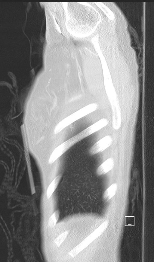 Bronchial atresia (Radiopaedia 73677-84470 Sagittal lung window 52).jpg