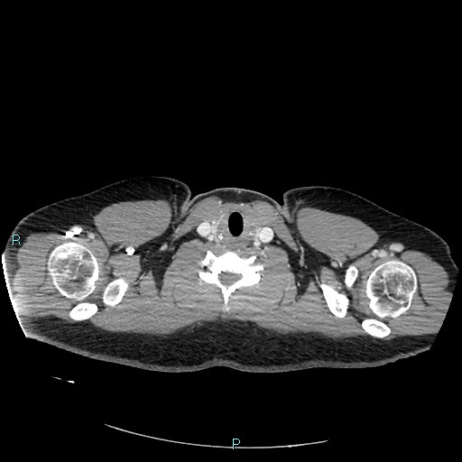 Bronchial carcinoid tumor (Radiopaedia 78272-90875 A 4).jpg
