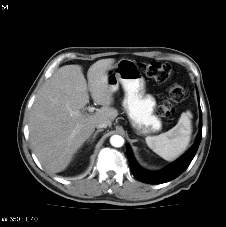 Bronchial carcinoid tumor with right lower lobe collapse (Radiopaedia 29060-29422 A 53).jpg