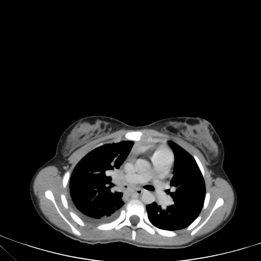 Bronchial mucoepidermoid carcinoma (Radiopaedia 57023-63895 Axial 46).jpg