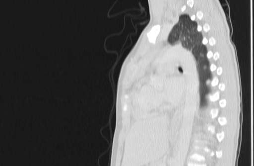 Bronchial mucoepidermoid carcinoma (Radiopaedia 57023-63895 Sagittal lung window 104).jpg