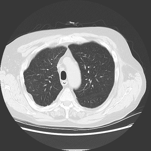 File:Bronchial stenosis - lung transplant (Radiopaedia 73133-83848 Axial lung window 19).jpg