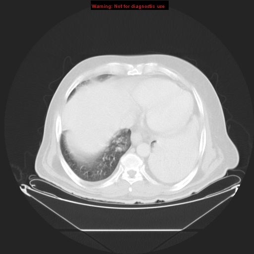 File:Bronchioloalveolar carcinoma (Radiopaedia 9272-9955 Axial lung window 24).jpg