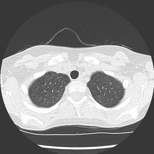 Bronchiolotis obliterans (Radiopaedia 73769-84575 Axial lung window 7).jpg