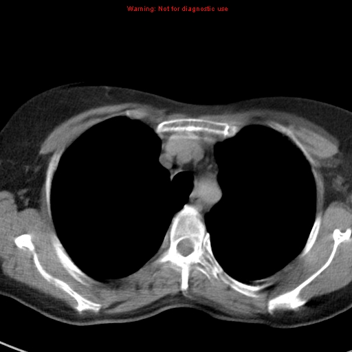 File:Bronchoalveolar carcinoma (BAC) (Radiopaedia 13436-13392 Axial non-contrast 13).jpg