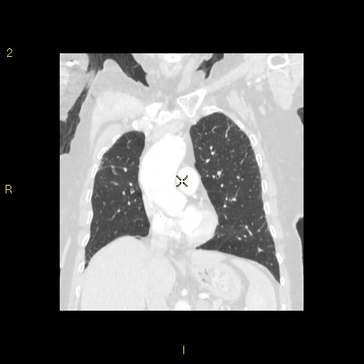 File:Bronchogenic carcinoma as an incidental finding (Radiopaedia 16453-16130 Coronal lung window 23).jpg