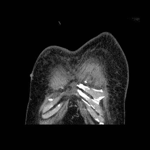 File:Bronchogenic carcinoma with metastatic lymphadenopathy (Radiopaedia 37671-39569 Coronal non-contrast 3).jpg