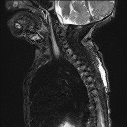 File:Bronchogenic cyst (Radiopaedia 27207-27380 Sagittal STIR 8).jpg