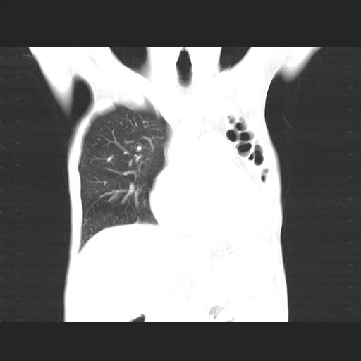 File:Bronchopleural fistula secondary to tuberculosis (Radiopaedia 20415-20322 Coronal lung window 7).jpg